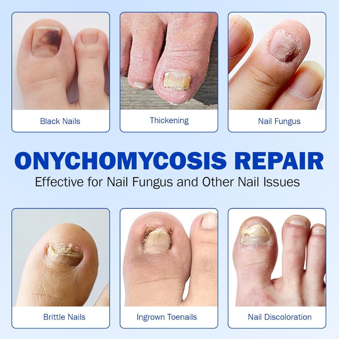 Fungal Nail Patches – 21 patches