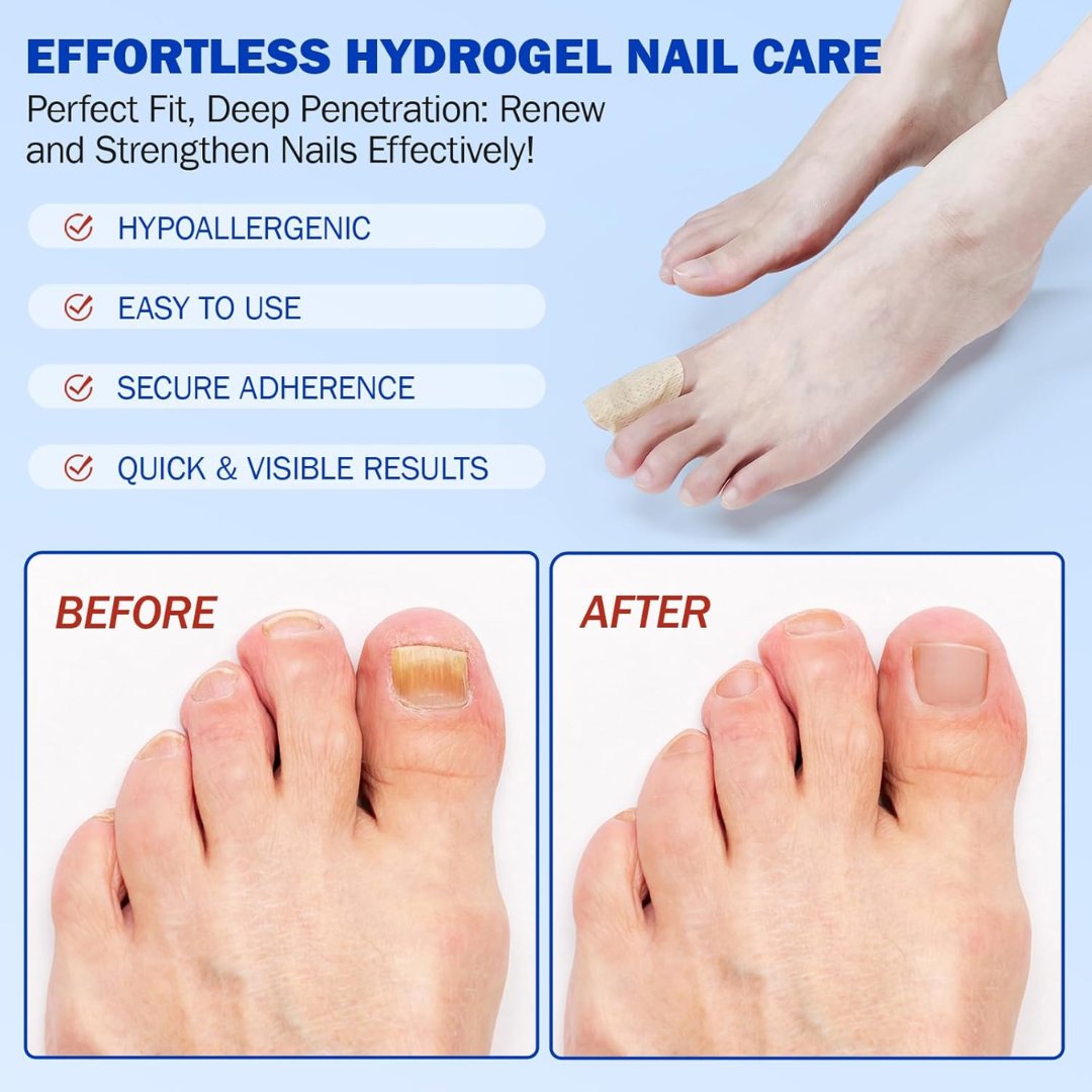 Fungal Nail Patches – 21 patches