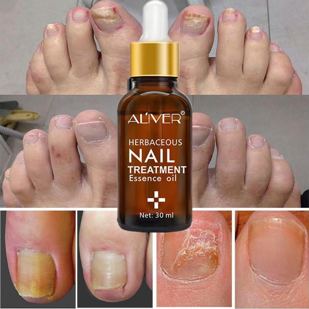 Herbaceous Nail Treatment Essence 30ml – Natural Anti-Fungal Treatment